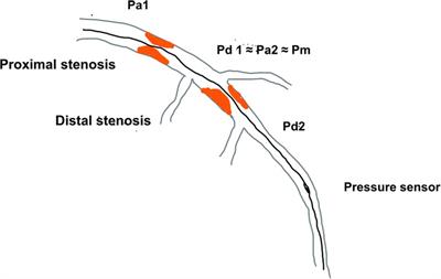 Serial stenosis assessment—can we rely on invasive coronary physiology